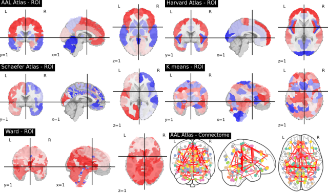 Figure 2: Extracted ROIs and Glass Brain Connectome (right bottom corner)